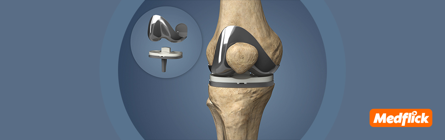 Best Knee Replacement Treatment in India | Cost, Hospitals & Top Doctors